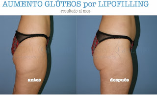 injerto_grasa_gluteos_aumento_cirujano_plastico