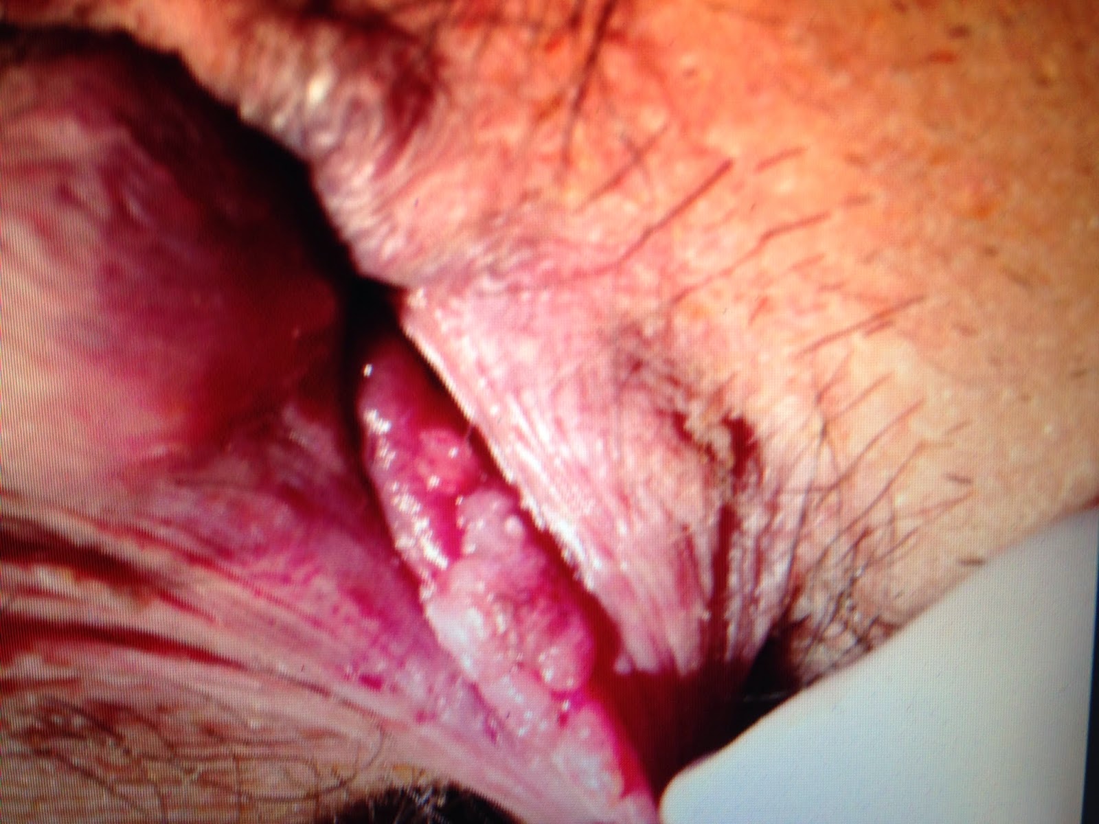 Blog do Saúde Médica Verrugas de HPV pênis e anal fotos e vídeo