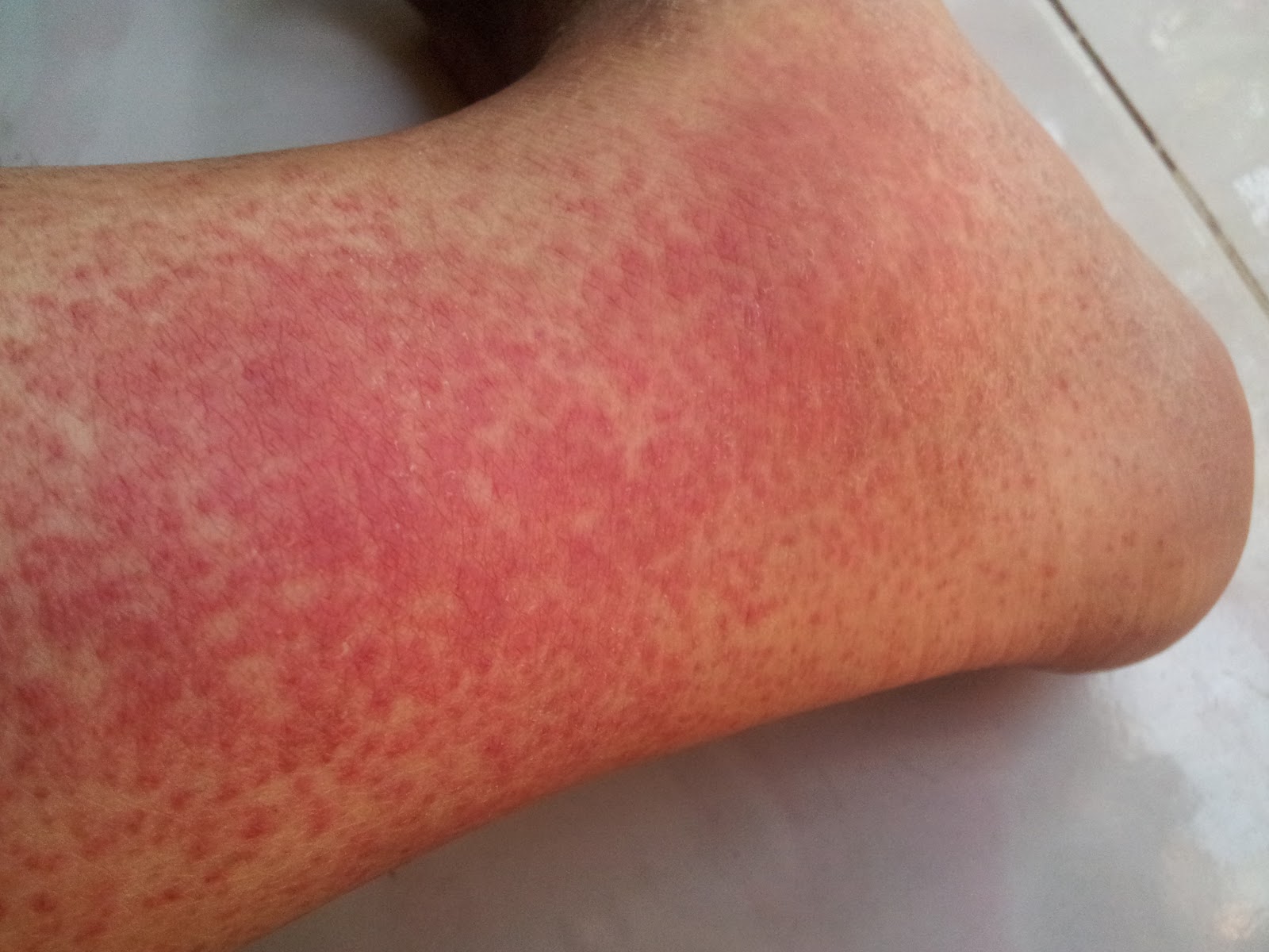 Akibat Alergik Ubat  IEZANA STORY