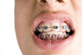 Braces still Bulky Braces bulkiness