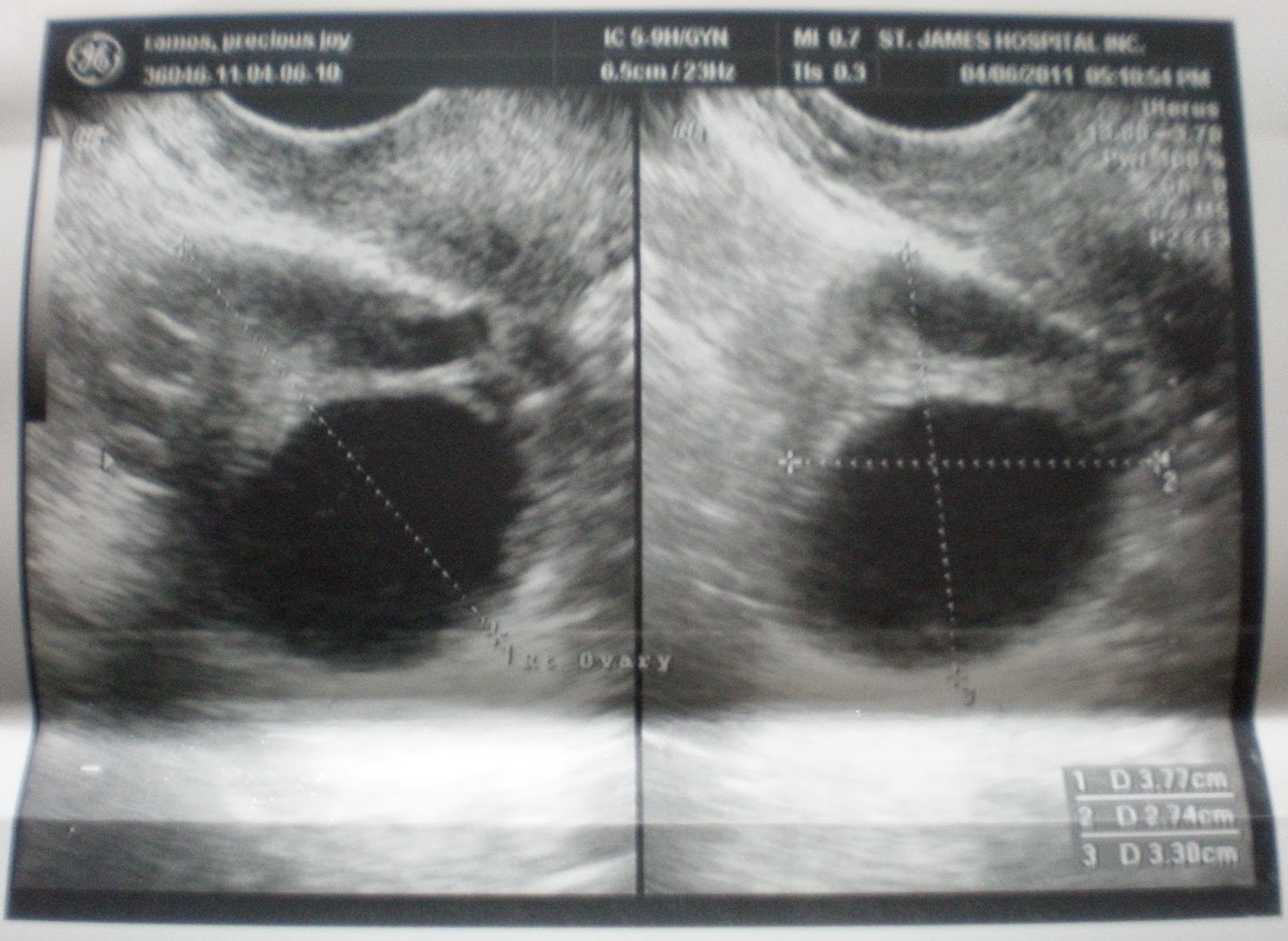 dominant follicle meaning in bengali