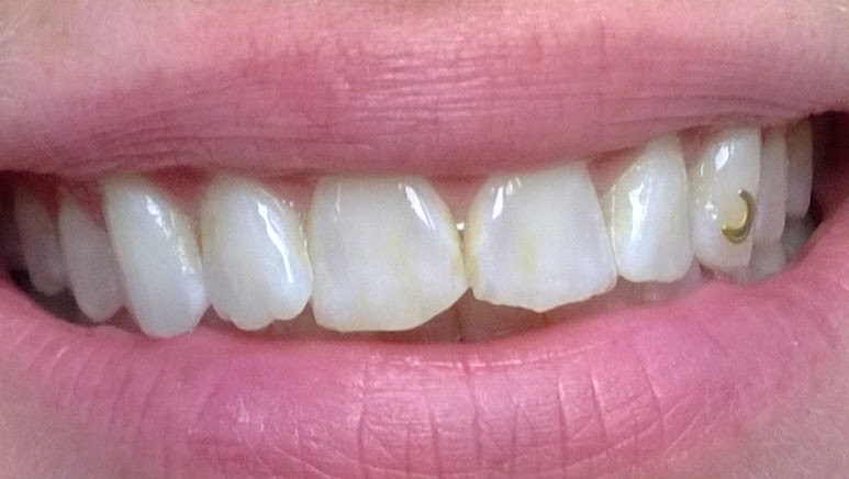 hammas laminaatti