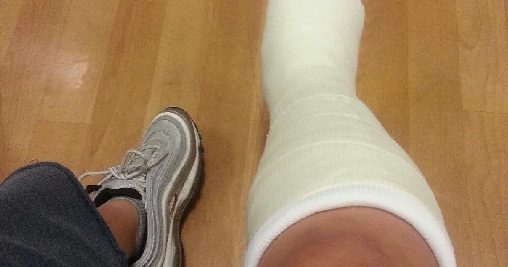 My Broken Ankle =( New Fiberglass Cast