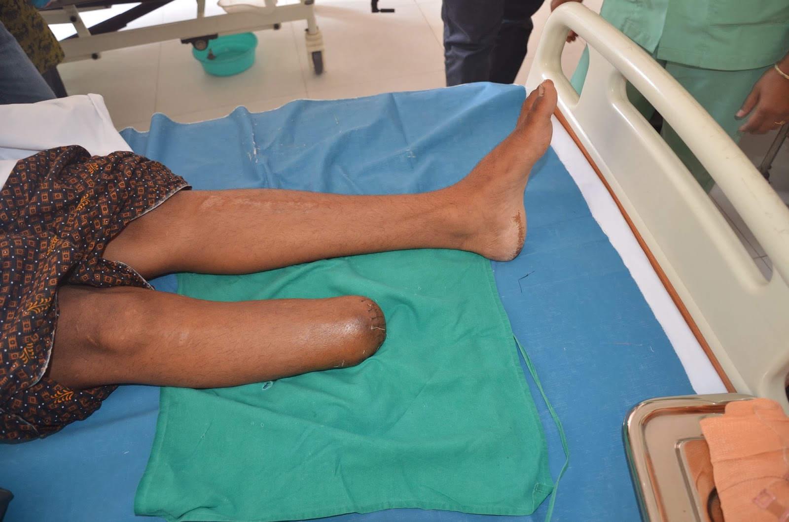 CRUSH INJURY FOOT WITH BONE LOSS AND NERVE INJURY BELOW KNEE