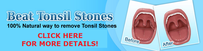 Cure Tonsil Stones