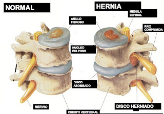 El dolor bajo la espátula a la derecha detrás de la espalda el tratamiento