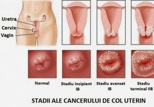 Miogyn Electronic Medical Office Cancerul De Col Uterin