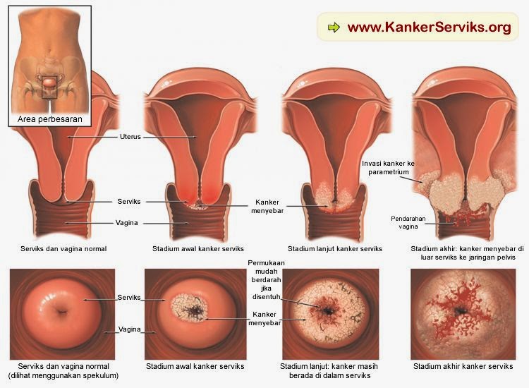 Obat Kanker Serviks dari bahan Herbal Manjur, obat kanker serviks ampuh stadium 1, pengobatan kanker serviks ampuh stadium 2  herbal