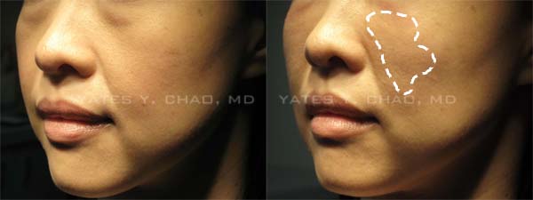 晶亮瓷蘋果肌注射Radiesse cheek augmentation 晶亮瓷蘋果肌注射Radiesse cheek augmentation