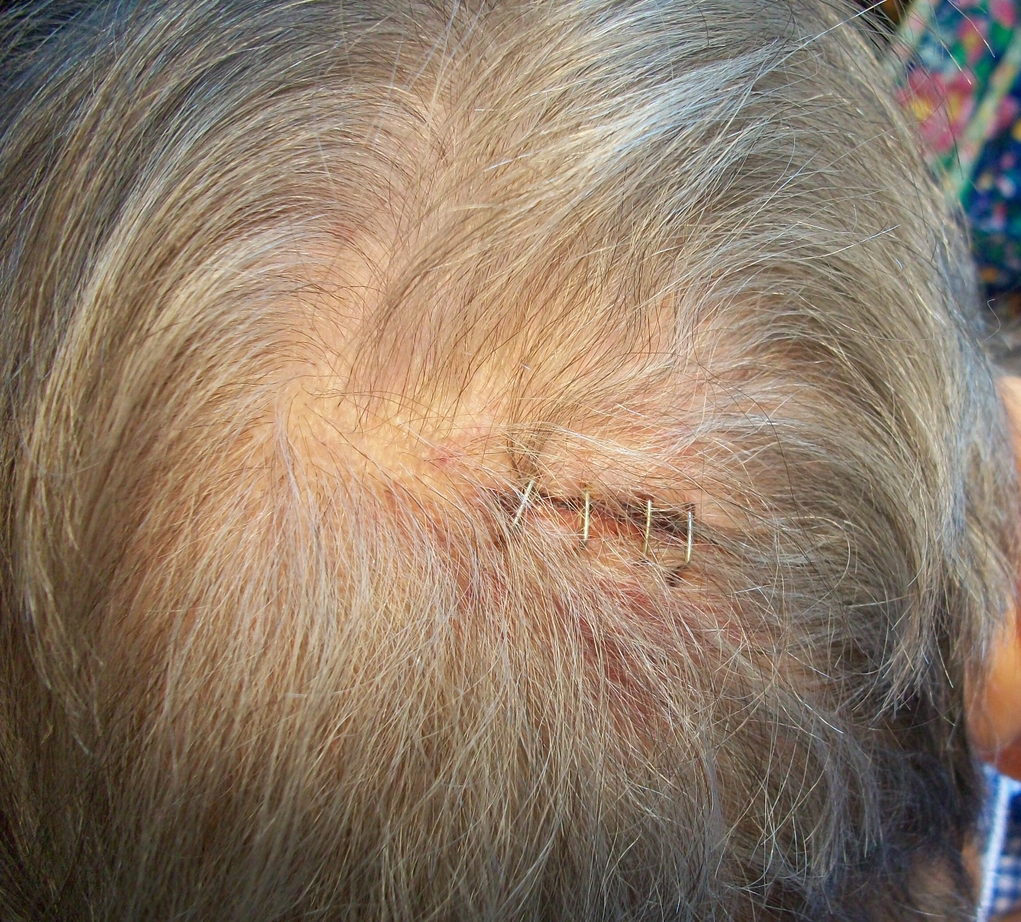 Albums 99+ Pictures Pictures Of Staples In Head Completed