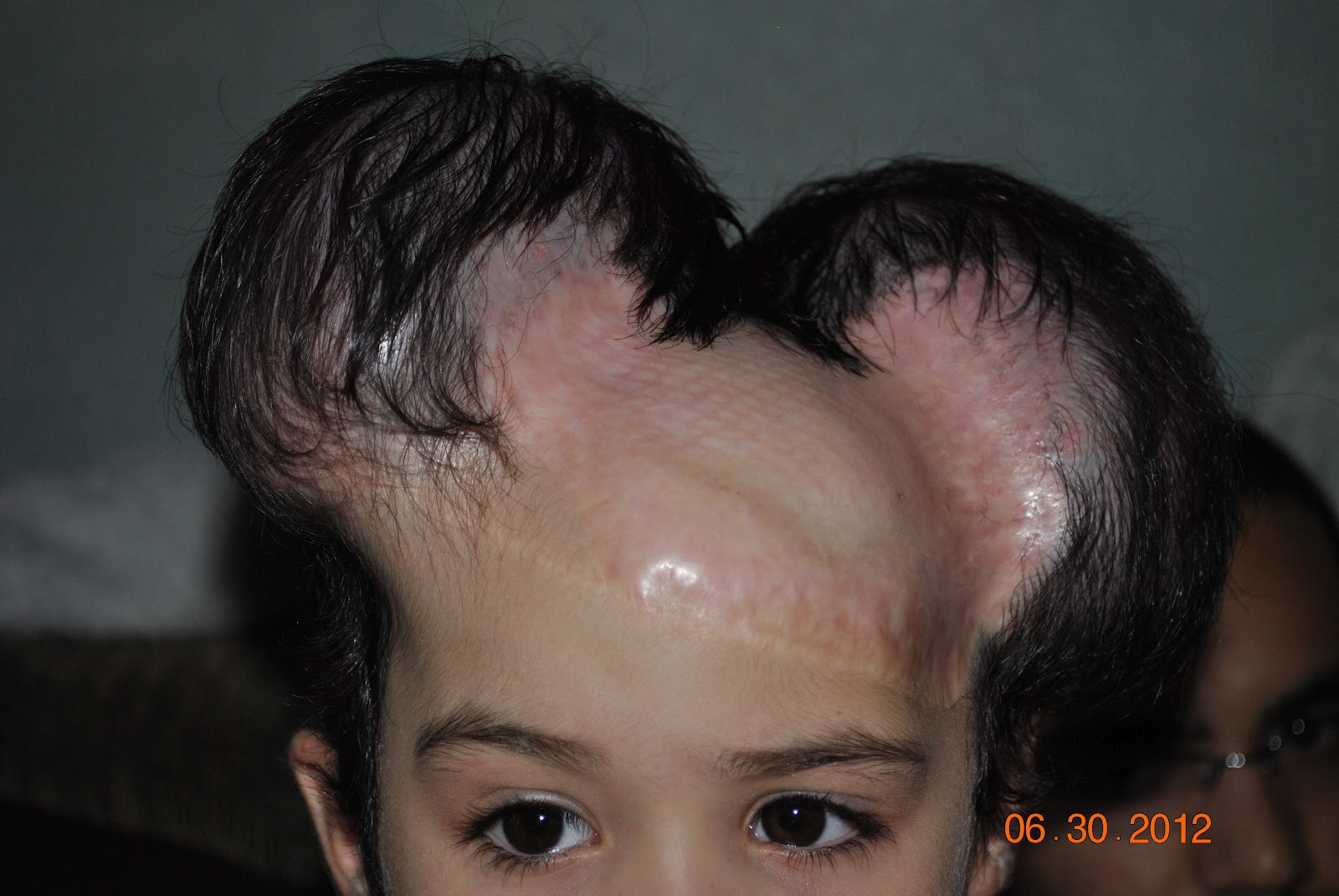 Age 4 Female Scalp Tissue Expanders Fifty Third Filling