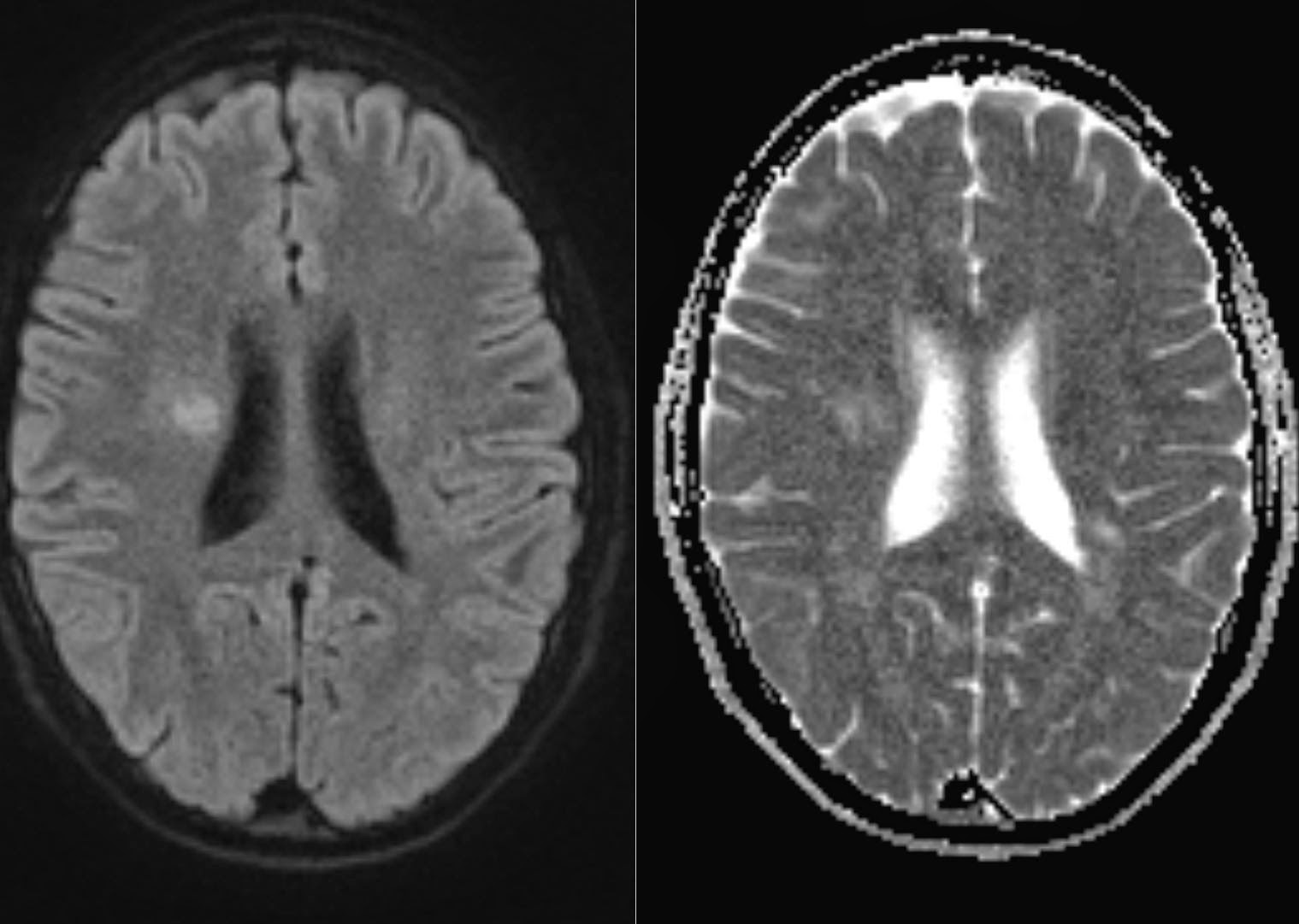 Radiology MRI Active MS plaques on DWI b1000