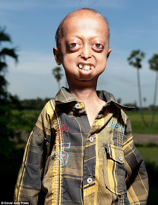 Ali Hussain Khan progeria