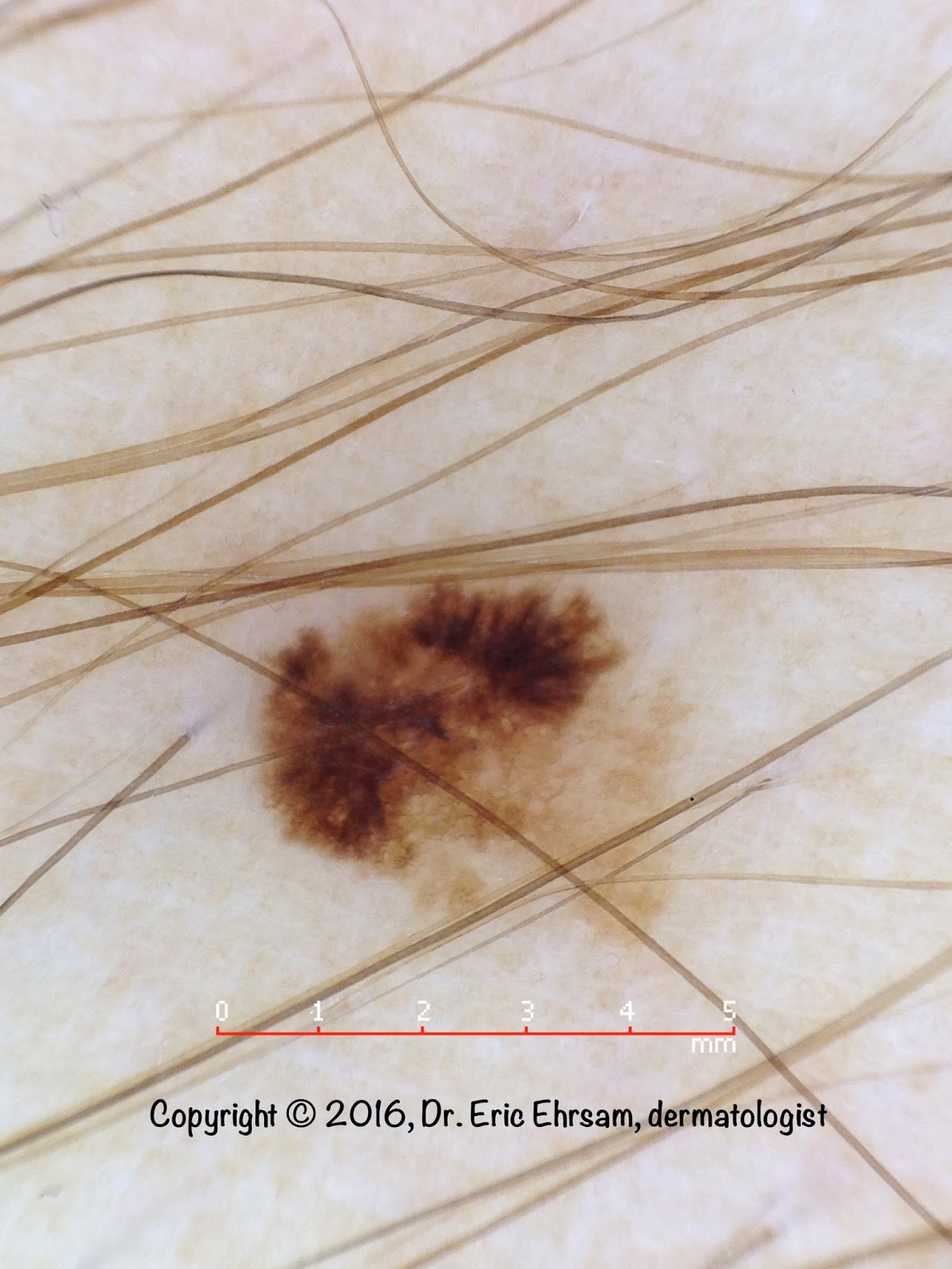 dermoscopy January 2016