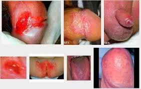 Sipilis Sipilis
