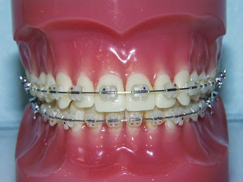 assurance dentaire pour appareils orthodontiques