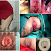 Obat BAB Berdarah Akibat Suka Pedas thumbnail