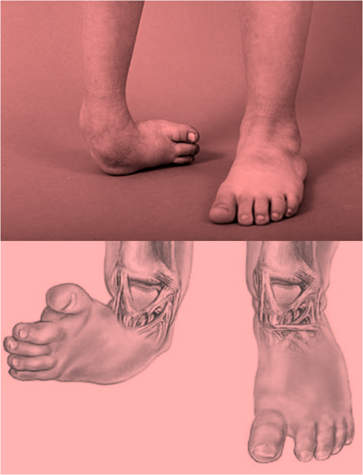 ¿QUÉ ES EL PIE EQUINOVARO? Enciclopedia de Tareas