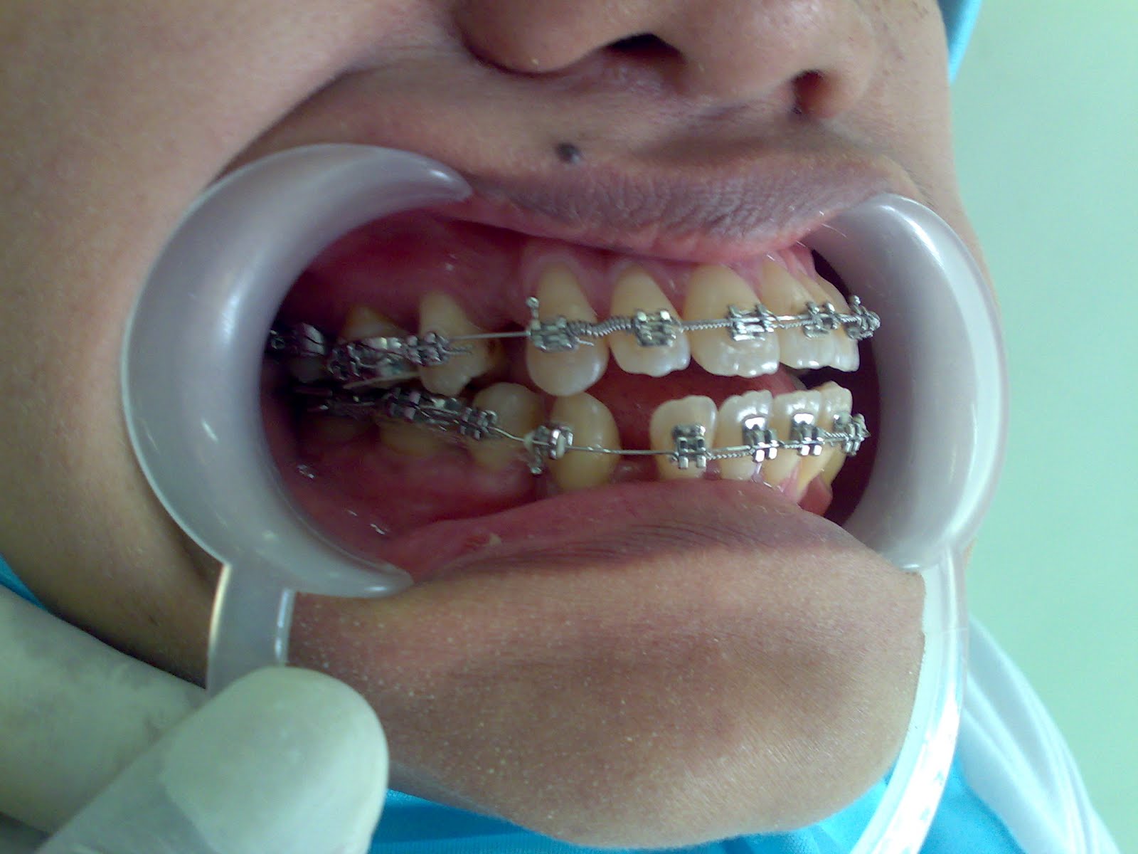 aryabrahmanta THE TREATMENT OF ANTERIOR OPEN BITE WITH EXTRACTION OF
