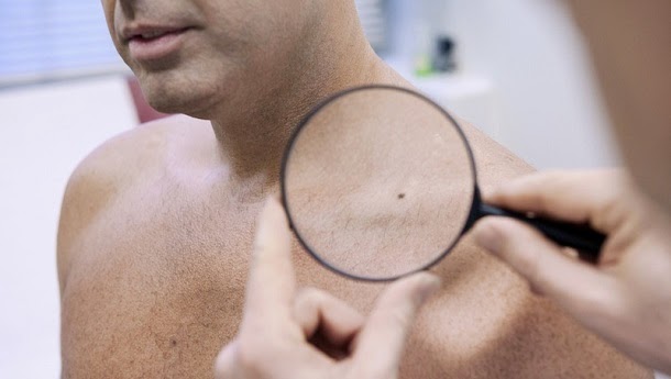 Anticorpo reduz em 40% avanço do melanoma