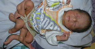 The birth of a child with six legs in southern Pakistan 