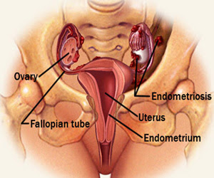 endometriosis pada wanita