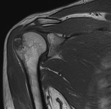 Isolated Avulsion of greater tuberosity of humerus | The ...