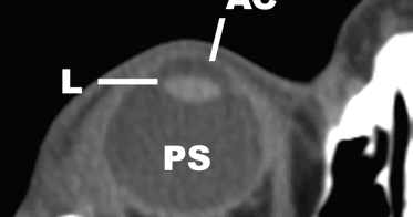 ct scan orbit axial view