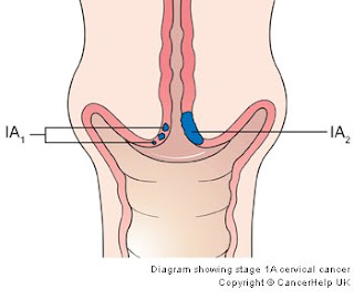ระยะ 1A มะเร็งปากมดลูก