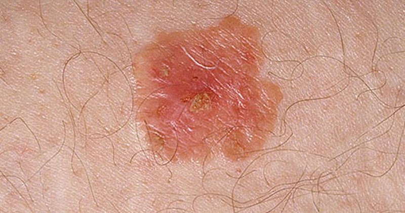 Pictures of skin cancer Skin cancer white spots