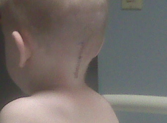 chiari surgery scars