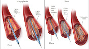 Stent en pacientes con Sindrome Coronario Agudo