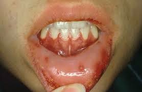 Herpes di Mulut