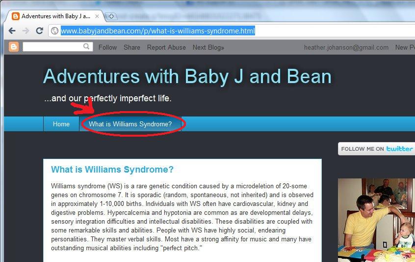 williams syndrome baby. Williams Syndrome?
