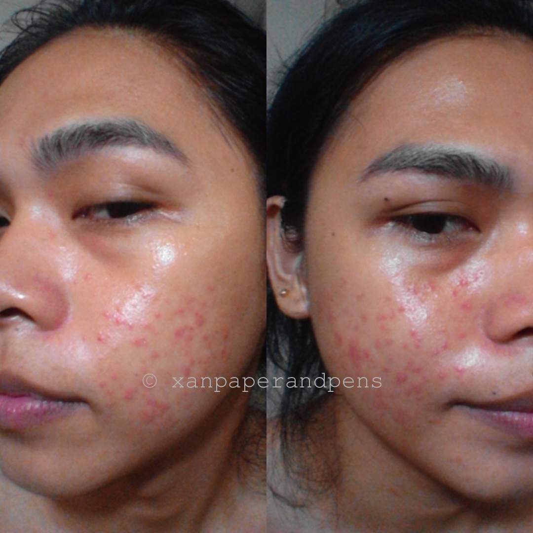 xanPaper and Pens What is Acne Purging?