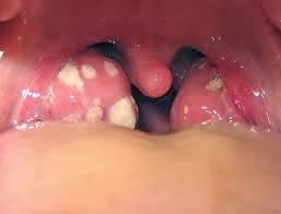 Rawat Tonsil dengan Vitamin Shaklee Rawat Tonsil dengan Vitamin Shaklee