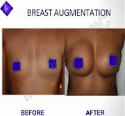 Breast Augmentation Delhi
