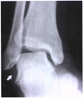 Ap Stress Projection Ankle X Ray Radtechonduty