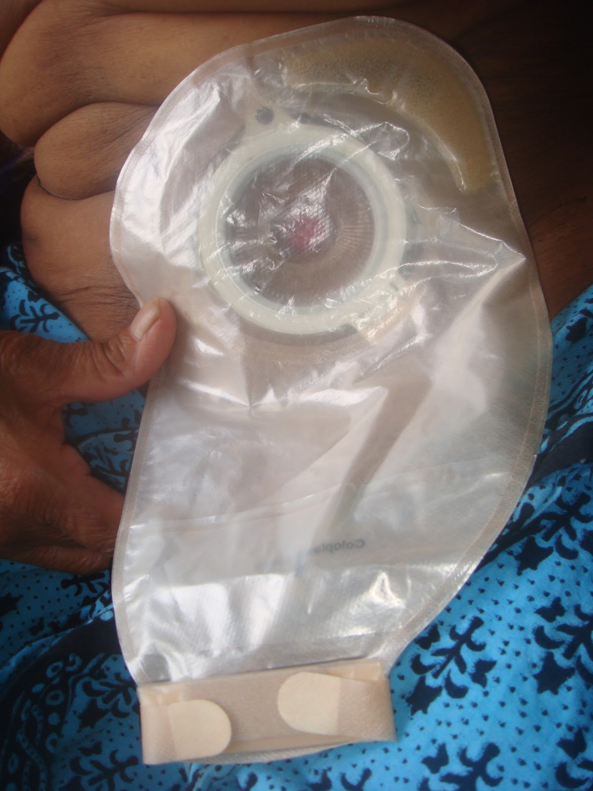 colostomy difference between bag stoma bags care application november many