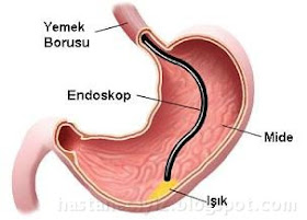 gastroskopi gastroskopi nasıl yapılır, gastroskopi işlemi nasıl olur