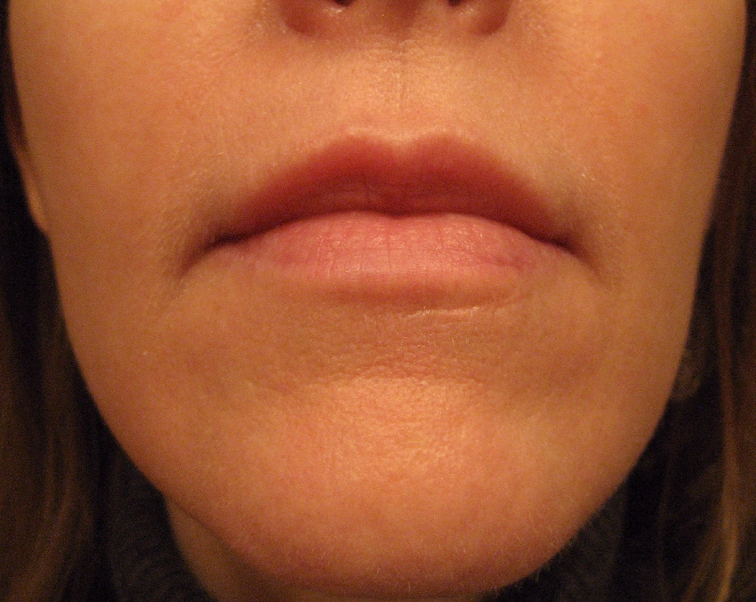 Chemical Peels for Acne and Anti Aging Above Lip Vertical Lines the