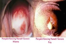 Penyakit Gonore Atau Kencing Nanah Penyakit Gonore Atau Kencing Nanah