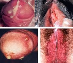 sipilis sipilis