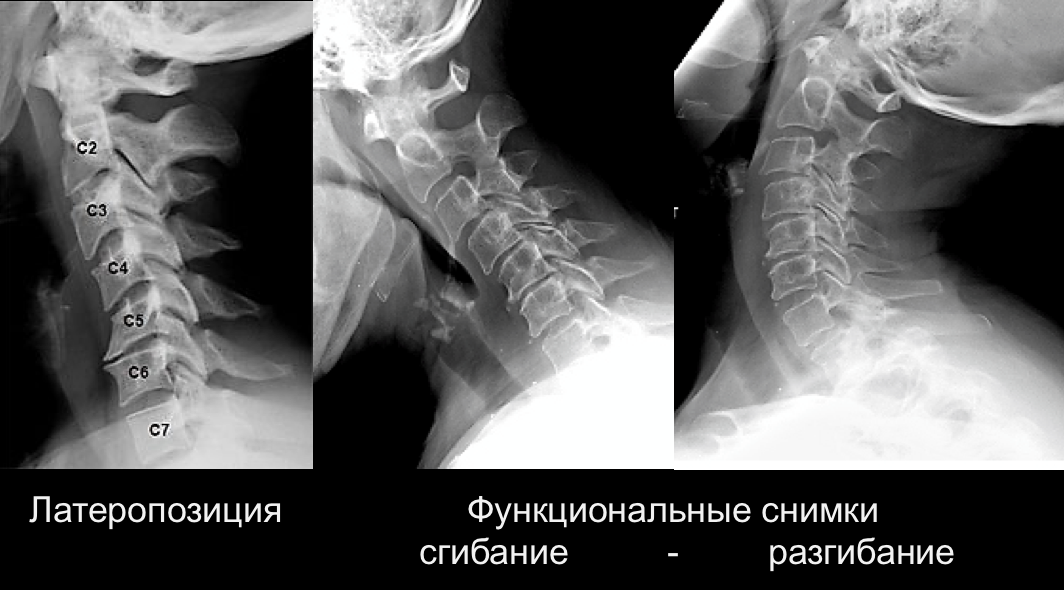 Как сделают рентген позвоночника шейного отдела позвоночника Как сделают рентген позвоночника шейного отдела позвоночника