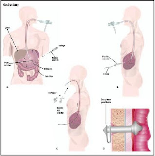 Nursing Diagnosis for Gastrostomy