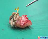 Broto de goiaba nasce dentro do dente cariado de um chinês
