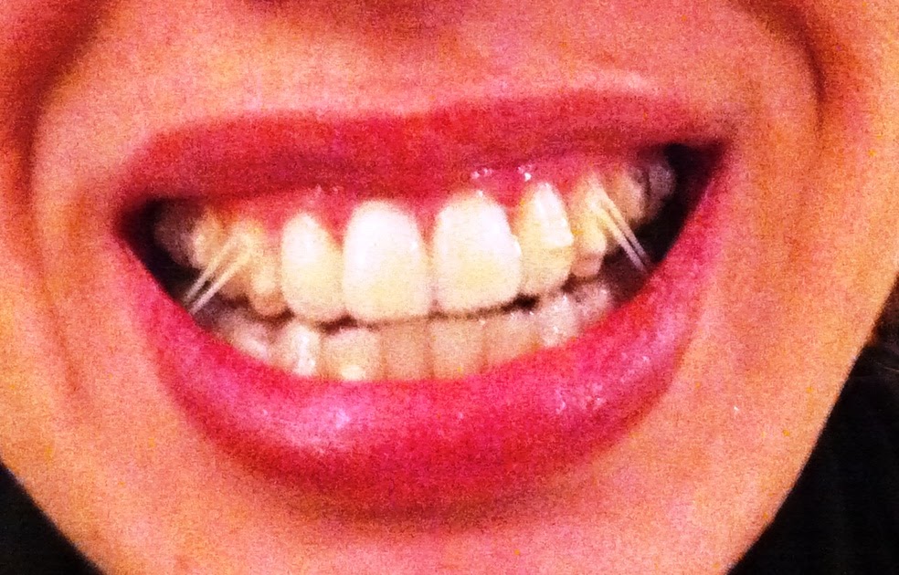 to my invisalign blog...... Not MORE rubber bands!!!!
