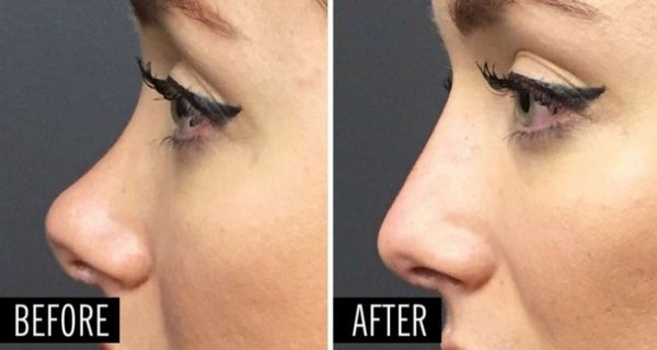 Improve The Look Of Your Nose Without Surgery! In Only 5 Minutes You Will Have A Completely New Nose That Looks Natural! Improve The Look Of Your Nose Without Surgery! In Only 5 Minutes You Will Have A Completely New Nose That Looks Natural!