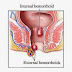 Obat Ambeien Atau Wasir thumbnail