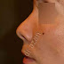 Rhinoplastie : nez courts et greffe d'extension septale